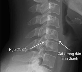 Cách chữa gai cột sống tại Cơ Xương Khớp Việt Đức - Ba Đình