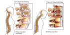 Nguyên nhân viêm cột sống dính khớp và cách chữa
